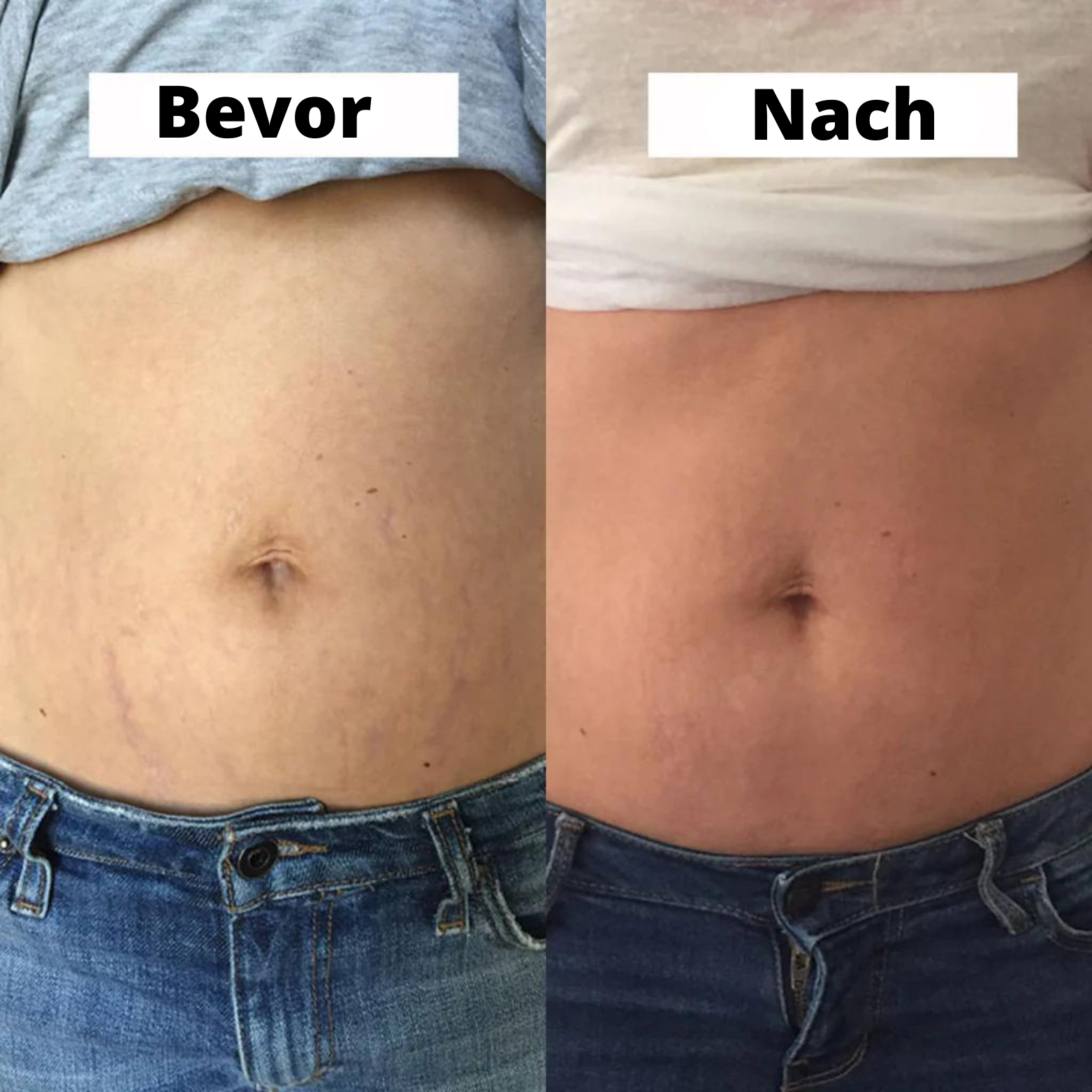 Bauchstraffende Creme